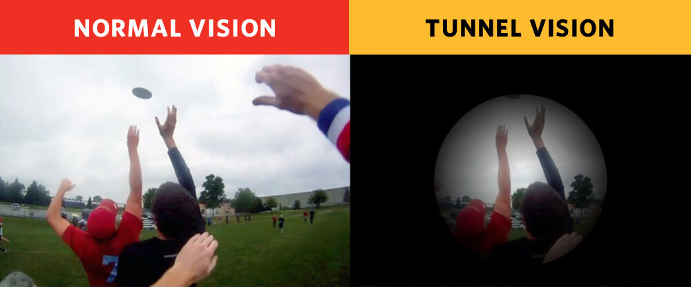 Tunnel Vision (Peripheral Vision Loss): Symptoms, Causes, Treatments