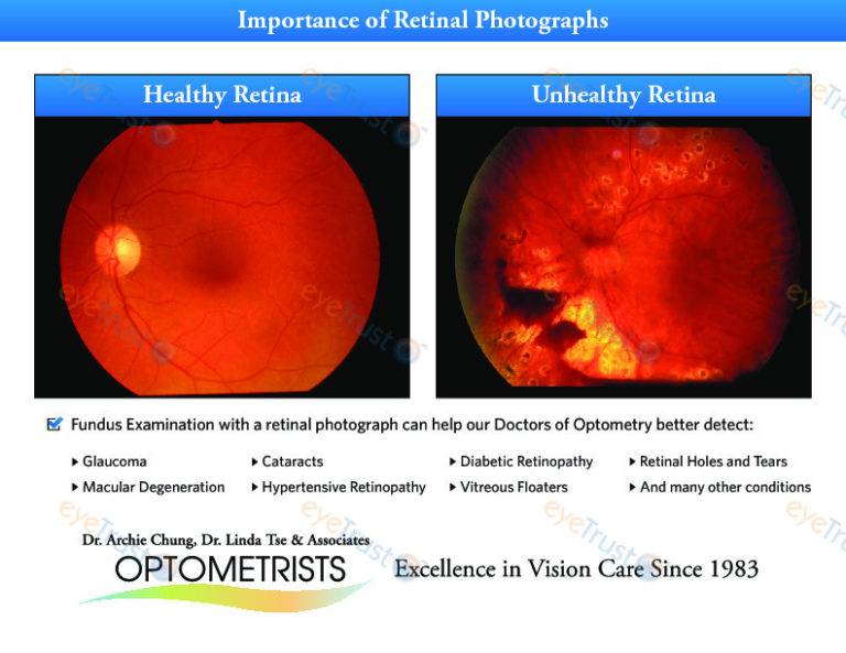 Retinal Photographs